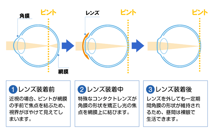 オルソケラトロジー治療の仕組み