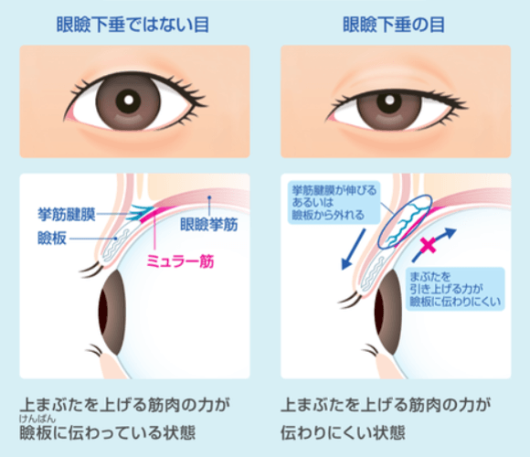 眼瞼下垂が起こるしくみ（腱膜性眼瞼下垂の場合）