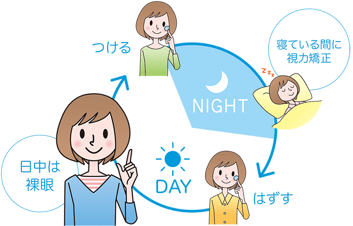 オルソケラトロジーの使い方｜夜に装用して朝外し、日中は裸眼で過ごすイメージ