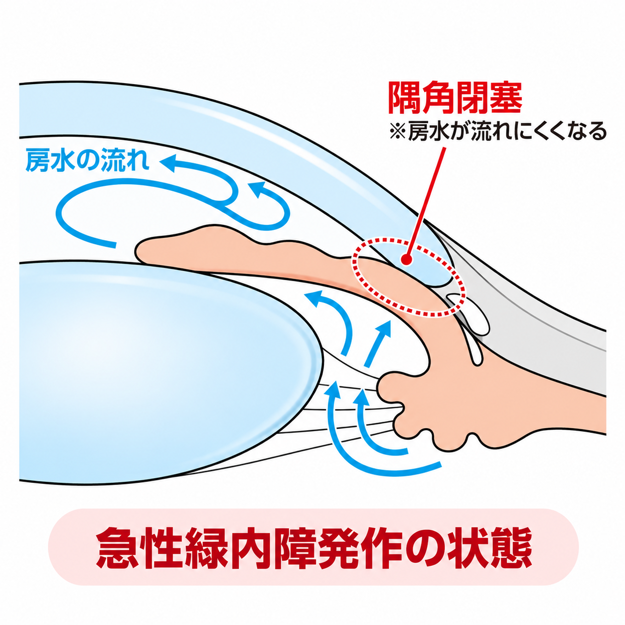 隅角閉塞を示す眼球断面図
